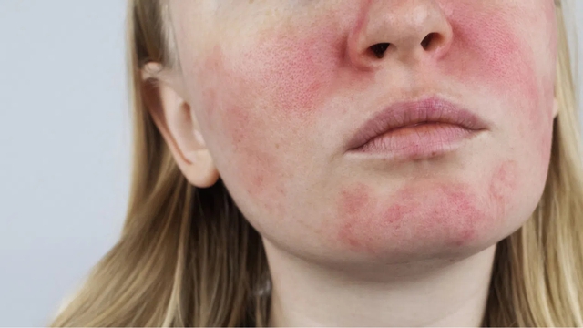 Peel da kh&ocirc;ng phải &ldquo;cứ l&agrave;m l&agrave; đẹp&rdquo;: Chuy&ecirc;n gia cảnh b&aacute;o 4 sai lầm khiến da c&agrave;ng ng&agrave;y c&agrave;ng tệ- Ảnh 2.