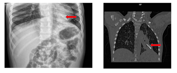 H&oacute;c kẽm nhung d&agrave;i 2cm, b&eacute; trai 3 tuổi phải mổ ngực khẩn cấp - Ảnh 1.