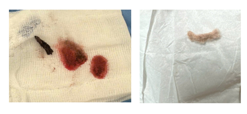 H&oacute;c kẽm nhung d&agrave;i 2cm, b&eacute; trai 3 tuổi phải mổ ngực khẩn cấp - Ảnh 2.