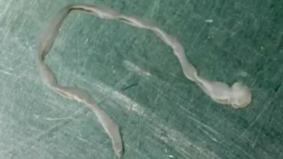 Người phụ nữ l&ecirc;n cơn co giật, b&aacute;c sĩ lấy ra thứ đ&aacute;ng sợ trong n&atilde;o - Ảnh 1.