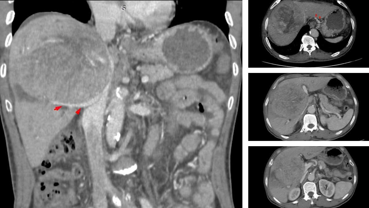 Mắc ung thư gan, được ti&ecirc;n lượng chỉ sống th&ecirc;m v&agrave;i th&aacute;ng, người đ&agrave;n &ocirc;ng H&agrave; Nội l&agrave;m được điều kh&oacute; tin- Ảnh 1.