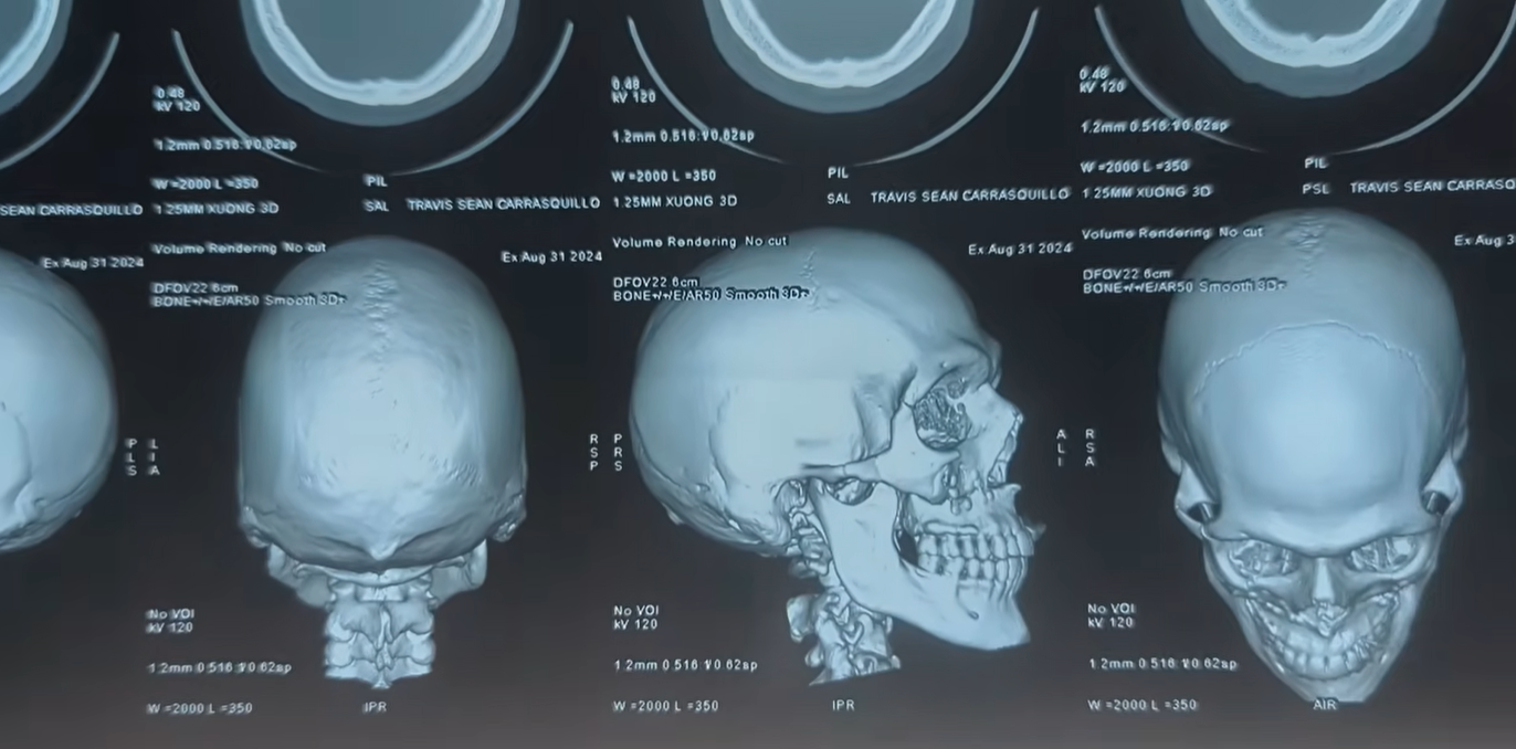 Kh&aacute;ch T&acirc;y phẫu thuật tại 1 bệnh viện ở Đ&agrave; Nẵng: "Nếu l&agrave;m ở Mỹ, t&ocirc;i sẽ phải nợ nần chồng chất trong &iacute;t nhất 10 năm"- Ảnh 3.