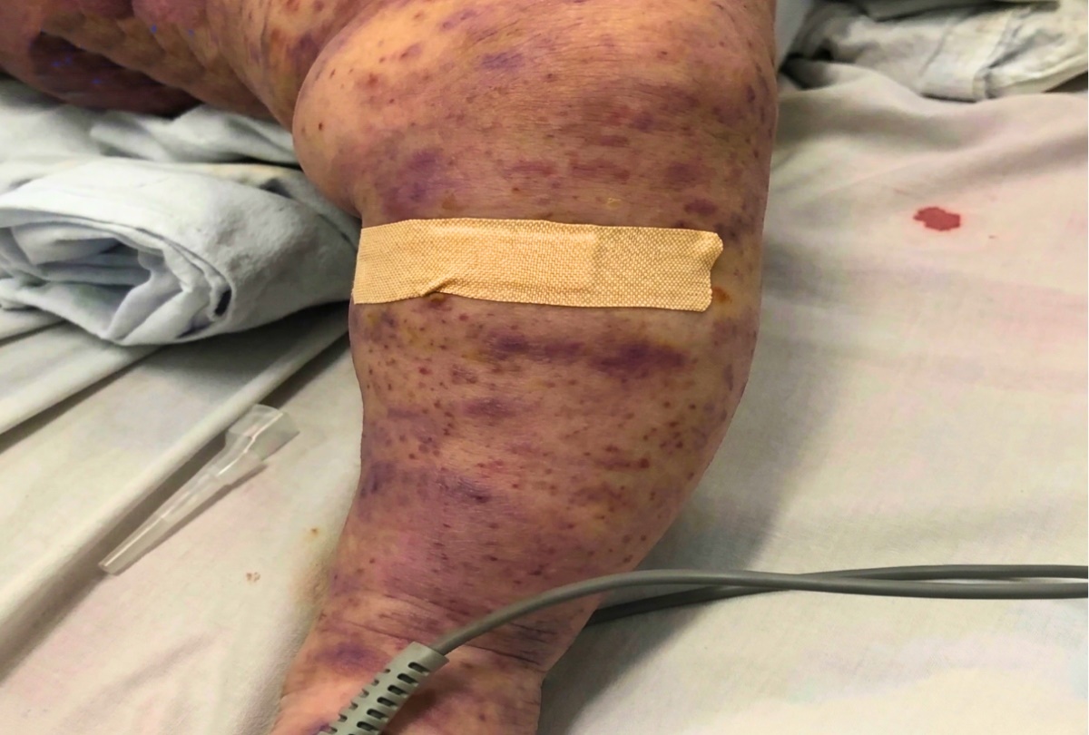 24 ca mắc, 4 ca tử vong, b&aacute;c sĩ ph&aacute;t cảnh b&aacute;o "n&oacute;ng" về căn bệnh g&acirc;y chết người trong 24h- Ảnh 2.