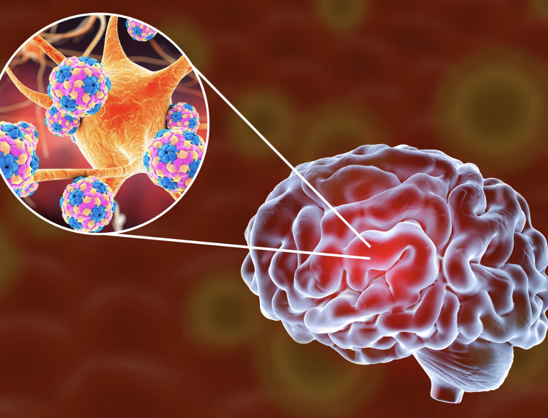 Bệnh nhi 2 tuổi bị vi&ecirc;m n&atilde;o m&ocirc; cầu đ&atilde; kh&ocirc;ng qua khỏi - Ảnh 1.