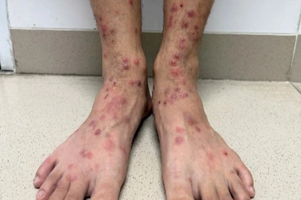 Sẩn ngứa do bọ ch&eacute;t - Ảnh 1.