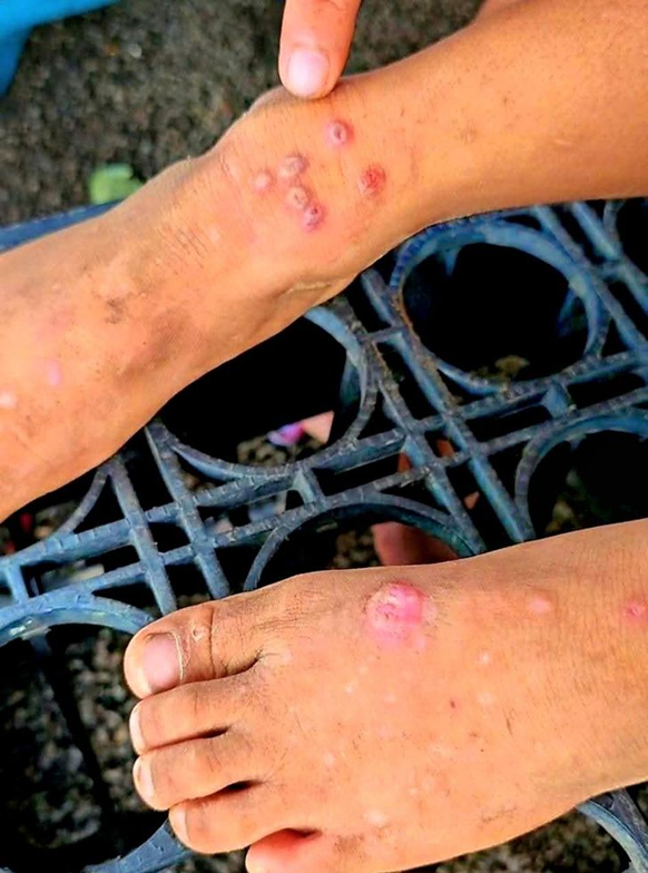 Th&aacute;i Lan bật cảnh b&aacute;o khi 23 người tử vong, 732 người bị l&acirc;y nhiễm 1 căn bệnh, ở Việt Nam cũng đ&atilde; xuất hiện- Ảnh 1.