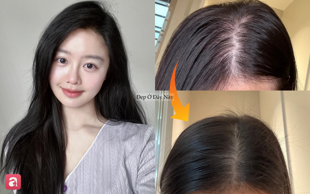 T&oacute;c rụng đến nỗi lộ cả mảng da đầu, t&ocirc;i quyết định theo 5 quy tắc chăm s&oacute;c sau để t&oacute;c đen d&agrave;y trở lại- Ảnh 1.