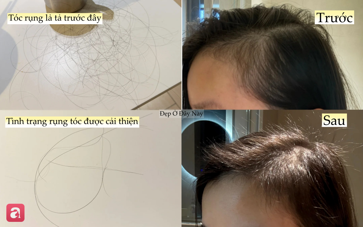 T&oacute;c rụng đến nỗi lộ cả mảng da đầu, t&ocirc;i quyết định theo 5 quy tắc chăm s&oacute;c sau để t&oacute;c đen d&agrave;y trở lại- Ảnh 3.