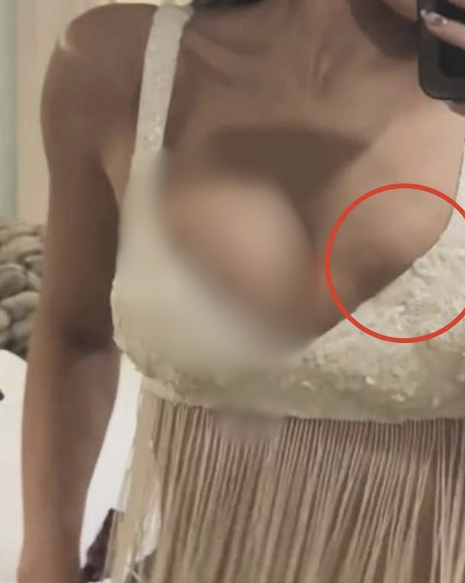 T&igrave;nh h&igrave;nh của Kylie Jenner sau nghi vấn vỡ t&uacute;i ngực ở Coachella- Ảnh 7.