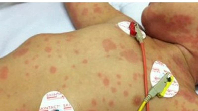 Đau bụng k&eacute;o d&agrave;i, đi kh&aacute;m mới biết mắc c&ugrave;ng l&uacute;c 2 khối ung thư - Ảnh 2.