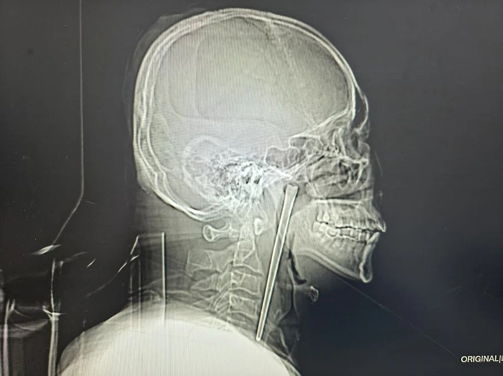 Hy hữu người đ&agrave;n &ocirc;ng Trung Quốc sống 8 năm với chiếc đũa kim loại mắc trong cổ họng- Ảnh 1.