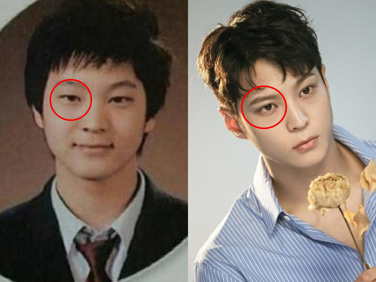 Mỹ nam tốn cả đống tiền &ldquo;dao k&eacute;o&rdquo;, nay bỗng gặp phải t&igrave;nh trạng mắt b&ecirc;n 1 m&iacute; - b&ecirc;n 2 m&iacute;- Ảnh 3.