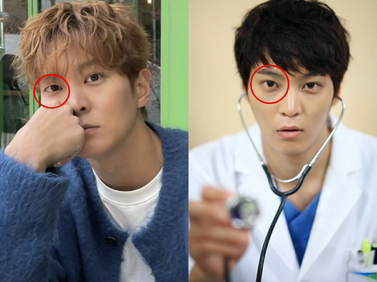 Mỹ nam tốn cả đống tiền &ldquo;dao k&eacute;o&rdquo;, nay bỗng gặp phải t&igrave;nh trạng mắt b&ecirc;n 1 m&iacute; - b&ecirc;n 2 m&iacute;- Ảnh 1.