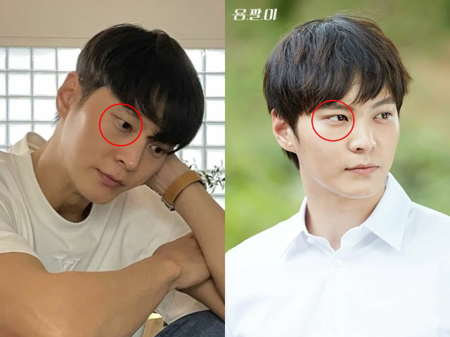 Mỹ nam tốn cả đống tiền &ldquo;dao k&eacute;o&rdquo;, nay bỗng gặp phải t&igrave;nh trạng mắt b&ecirc;n 1 m&iacute; - b&ecirc;n 2 m&iacute;- Ảnh 2.