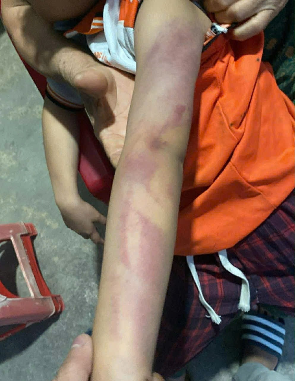 B&eacute; g&aacute;i lớp 2 bị bạn nam c&ugrave;ng lớp d&ugrave;ng thước dẻo đ&aacute;nh th&acirc;m t&iacute;m người v&igrave; kh&ocirc;ng cho kẹo - Ảnh 2.