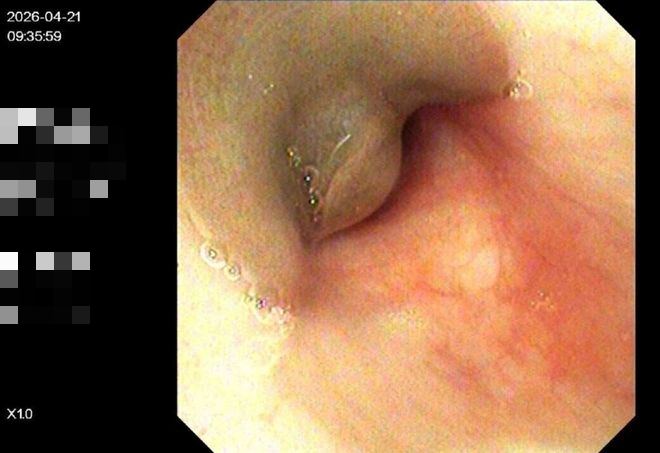 B&eacute; trai 8 tuổi ho ra m&aacute;u suốt 10 ng&agrave;y, b&aacute;c sĩ gắp được "thủ phạm" h&uacute;t m&aacute;u d&agrave;i 8cm đang ngo ngoe b&ograve; trườn - Ảnh 2.