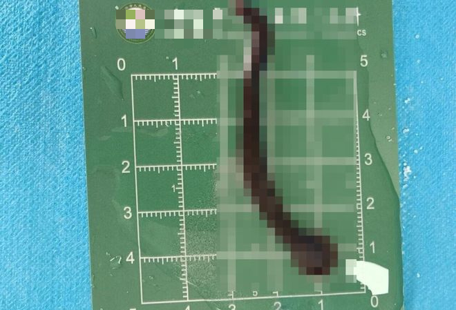 B&eacute; trai 8 tuổi ho ra m&aacute;u suốt 10 ng&agrave;y, b&aacute;c sĩ gắp được "thủ phạm" h&uacute;t m&aacute;u d&agrave;i 8cm đang ngo ngoe b&ograve; trườn - Ảnh 3.