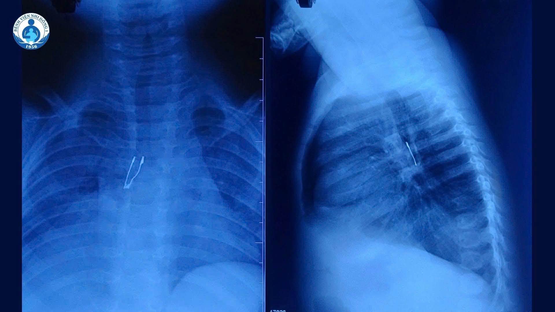 B&aacute;c sĩ th&oacute;t tim gắp đ&egrave;n led nằm trong phế quản b&eacute; 9 th&aacute;ng tuổi - Ảnh 1.