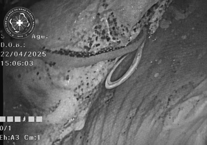 Đi si&ecirc;u &acirc;m, người đ&agrave;n &ocirc;ng sốc nặng khi thấy thứ "đ&aacute;ng sợ" sống trong bụng m&igrave;nh - Ảnh 1.