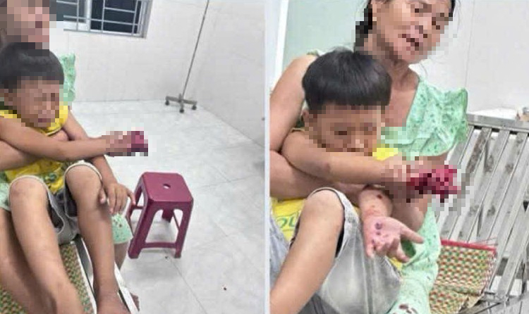 Ch&aacute;u b&eacute; bị dập b&agrave;n tay nghi do điện thoại nổ l&uacute;c sạc pin - Ảnh 1.