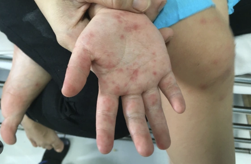 L&agrave;m g&igrave; để giảm nguy cơ tử vong v&agrave; di chứng do bệnh tay ch&acirc;n miệng?- Ảnh 1.