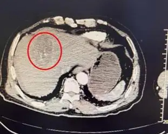 Người phụ nữ 70 tuổi vỡ khối u gan v&igrave; nhảy m&uacute;a 