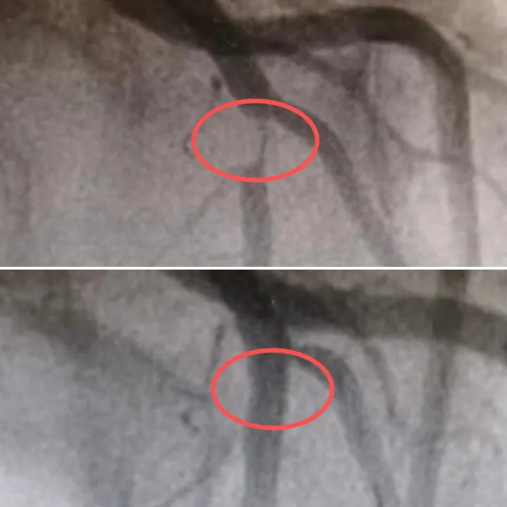 Nữ nh&acirc;n vi&ecirc;n văn ph&ograve;ng mới 27 tuổi m&agrave; 95% động mạch v&agrave;nh đ&atilde; tắc nghẽn v&igrave; th&oacute;i quen nhiều người l&agrave;m mỗi ng&agrave;y- Ảnh 1.