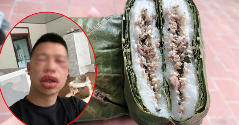 Vừa ăn hải sản xong đ&atilde; đỏ mặt, nổi mẩn khắp người? B&aacute;c sĩ l&ecirc;n tiếng cảnh b&aacute;o - Ảnh 2.