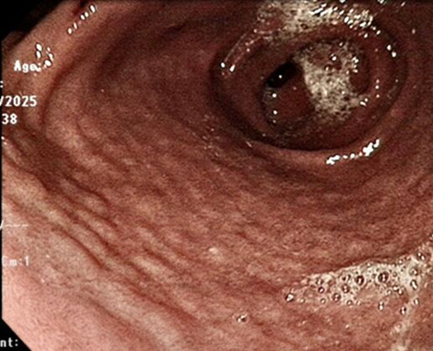 Nam sinh 15 tuổi n&ocirc;n ra m&aacute;u, nội soi thấy 