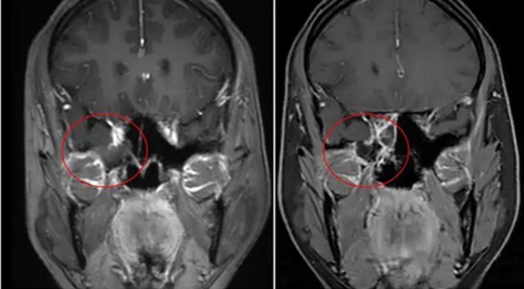 Chảy &ldquo;nước mũi&rdquo; suốt 20 ng&agrave;y, người phụ nữ bất ngờ khi ph&aacute;t hiện&hellip; n&atilde;o bị r&ograve; rỉ- Ảnh 1.