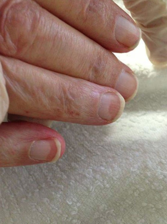 Gan "k&ecirc;u cứu" bằng c&aacute;ch ph&aacute;t ra dấu hiệu n&agrave;y ở m&oacute;ng tay: Kiểm tra ngay xem bạn c&oacute; kh&ocirc;ng- Ảnh 1.