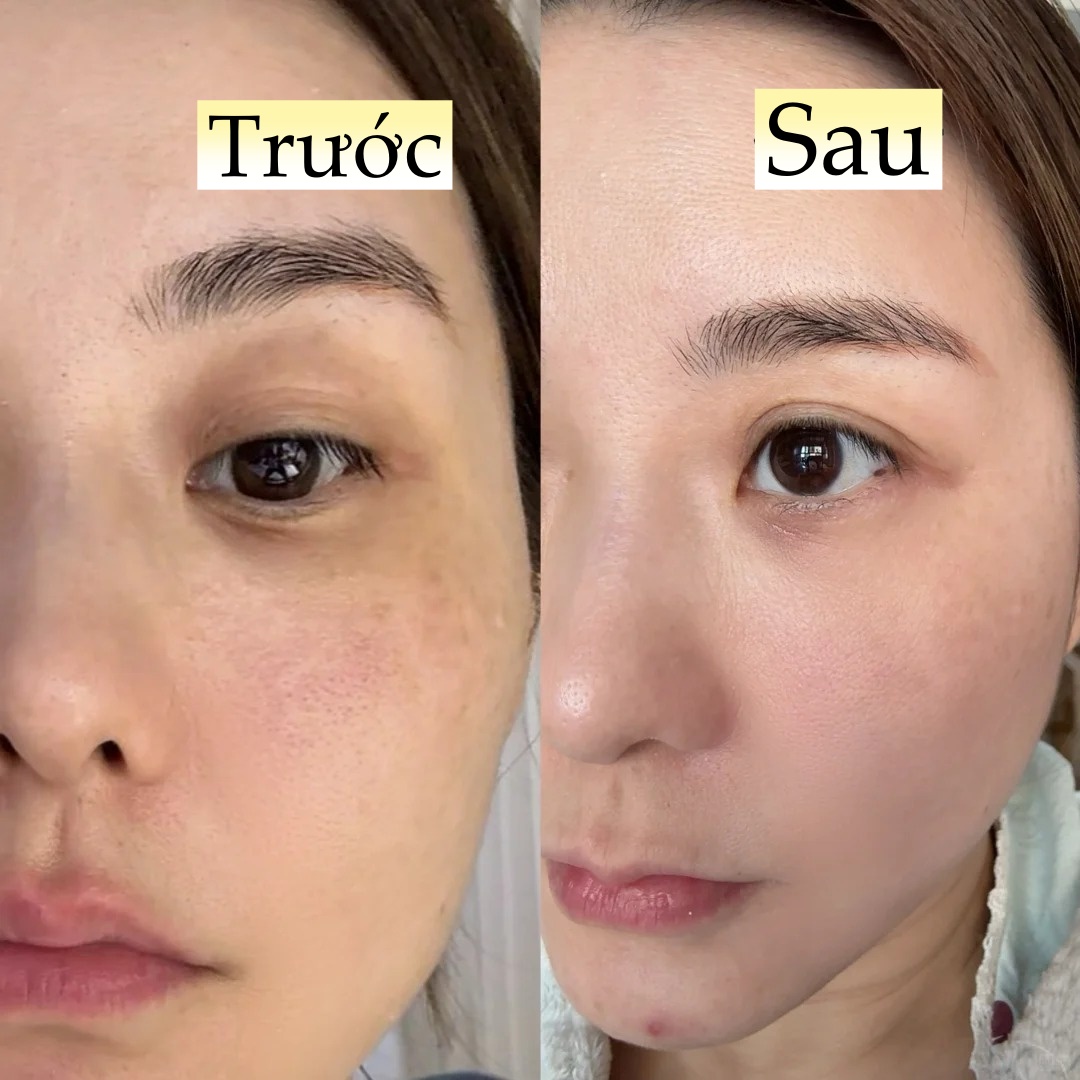 Đi ngủ sớm v&agrave; b&ocirc;i thứ n&agrave;y l&ecirc;n da mỗi tối, l&agrave;n da của t&ocirc;i sau 1 th&aacute;ng đ&atilde; thay đổi ho&agrave;n to&agrave;n- Ảnh 8.