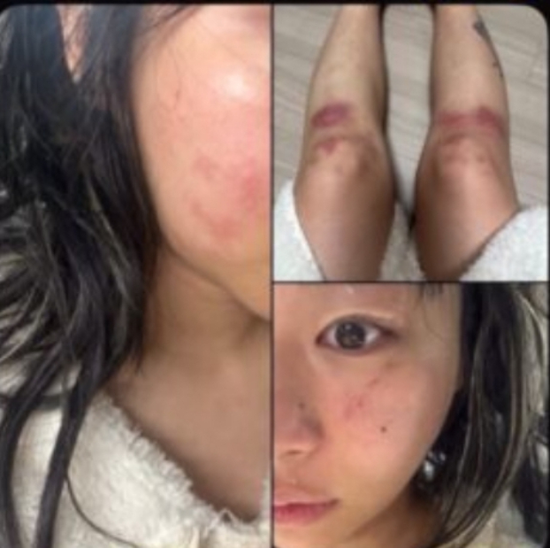 Nữ ca sĩ y&ecirc;u lại bạn trai cũ từng đ&aacute;nh c&ocirc; bầm dập to&agrave;n th&acirc;n: &ldquo;T&ocirc;i kh&ocirc;ng kiện anh ấy nữa&rdquo;- Ảnh 3.