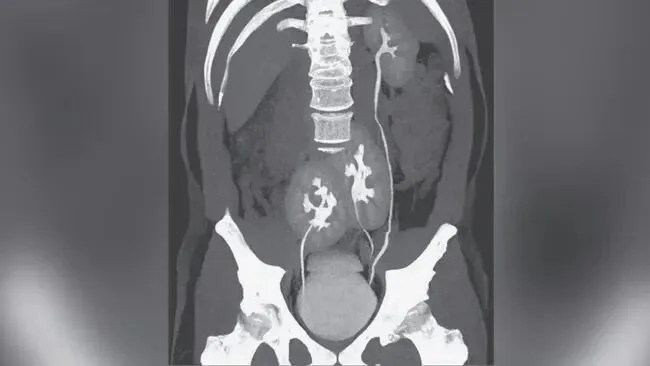 Đi kh&aacute;m nhiễm tr&ugrave;ng tiết niệu, người đ&agrave;n &ocirc;ng 31 tuổi ph&aacute;t hiện c&oacute; 3 quả thận- Ảnh 3.