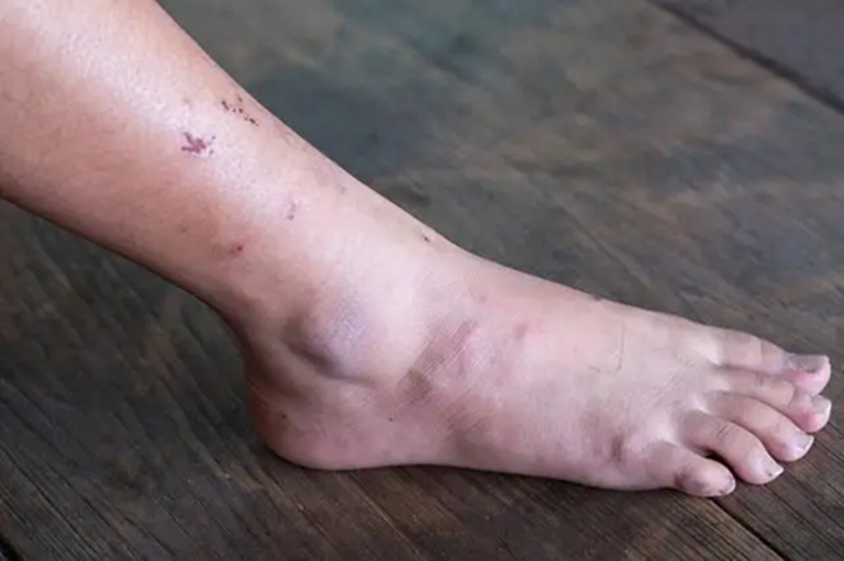 Khi ung thư mới bắt đầu h&igrave;nh th&agrave;nh, người ta thường cảm thấy 3 điều kh&ocirc;ng ổn, nhưng &iacute;t ai ch&uacute; &yacute; đến- Ảnh 2.