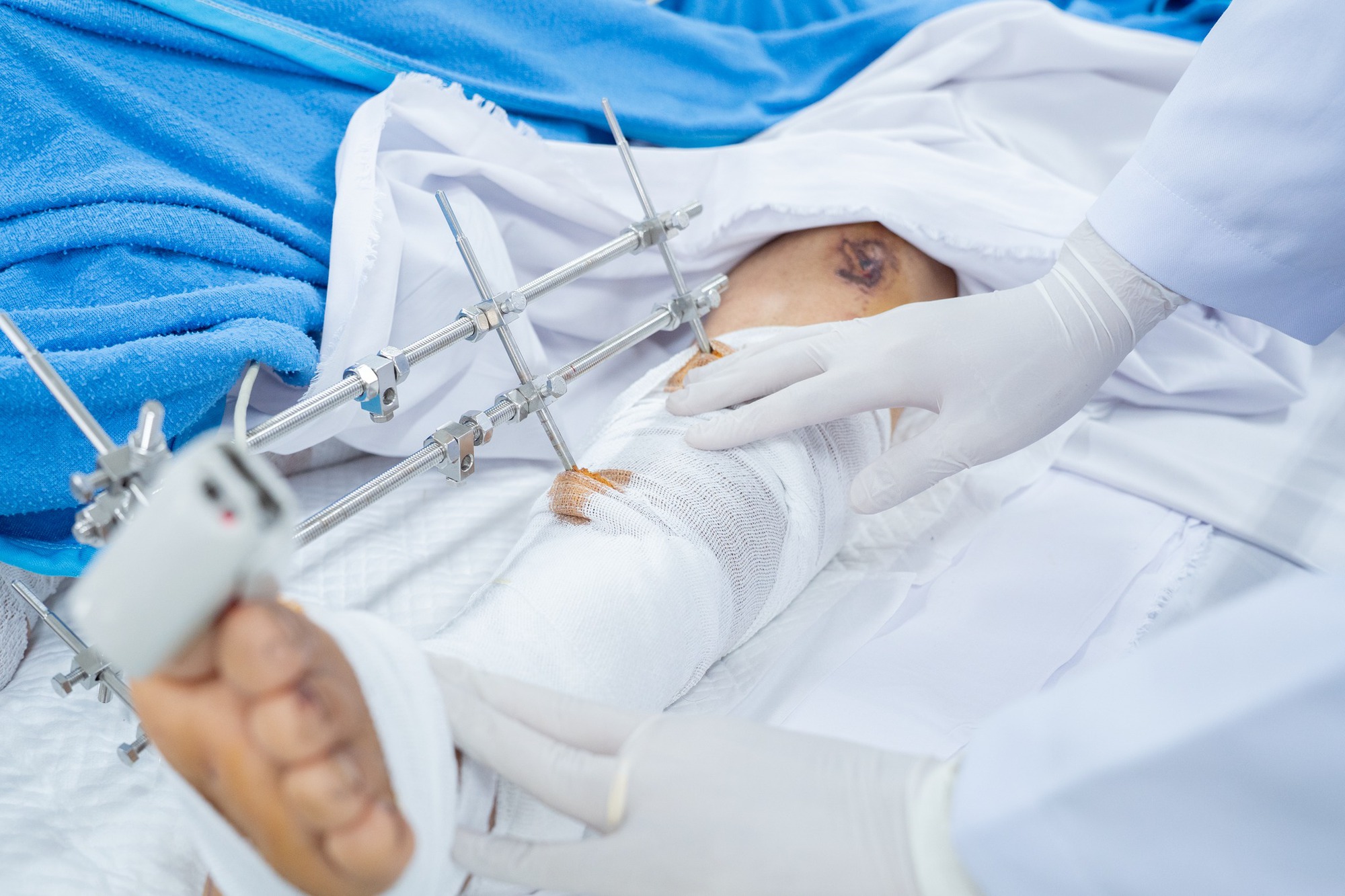 B&aacute;c sĩ Bệnh viện Chợ Rẫy mổ xuy&ecirc;n đ&ecirc;m cứu 2 nạn nh&acirc;n vụ xe kh&aacute;ch rơi xuống vực - Ảnh 2.