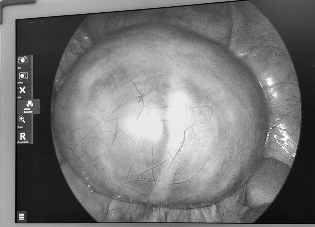 Đau bụng nhưng chủ quan, người phụ nữ sốc khi b&aacute;c sĩ gắp ra thứ "đ&aacute;ng sợ" b&ecirc;n trong - Ảnh 1.