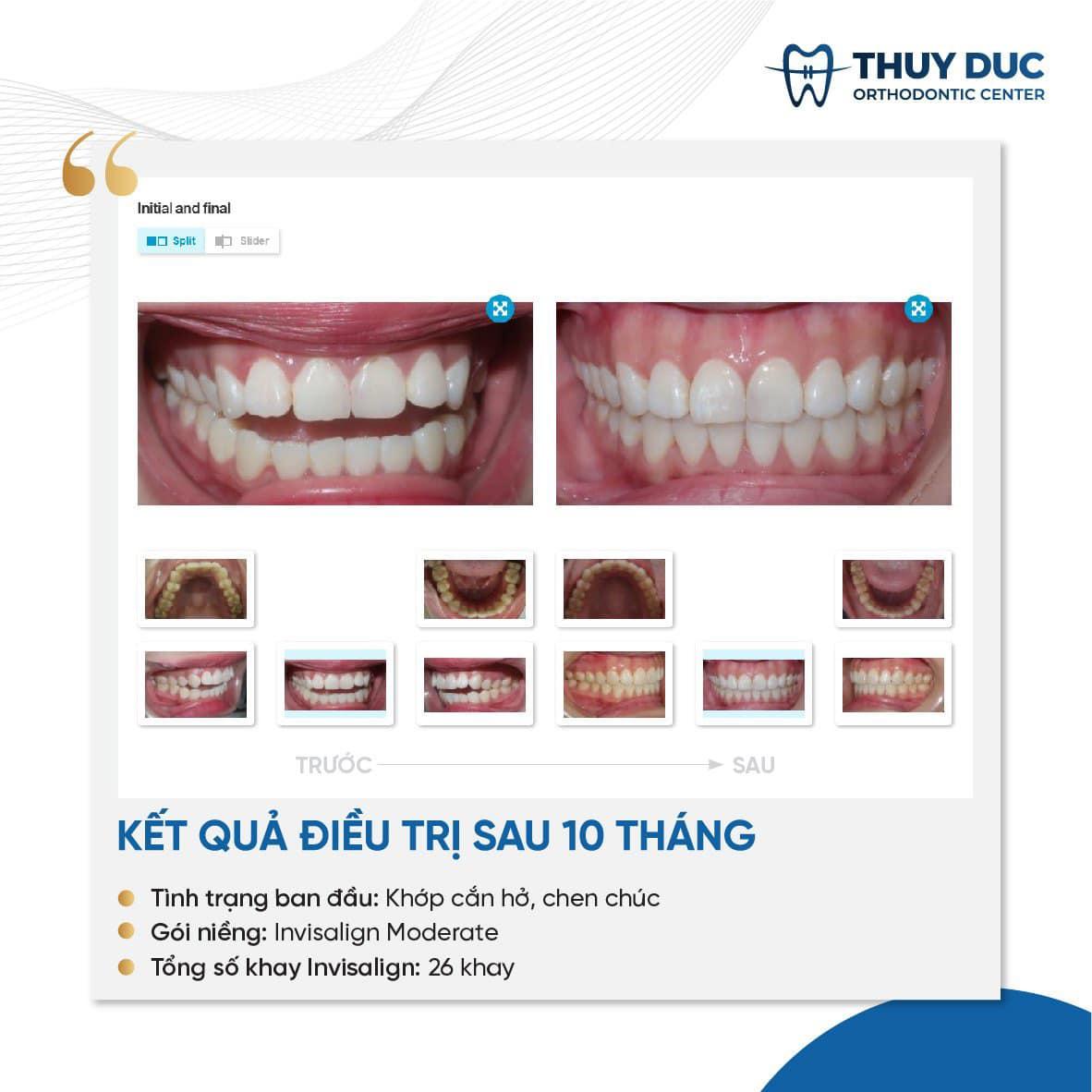 Niềng răng Invisalign: C&ocirc;ng nghệ chỉ được ph&aacute;t huy khi đặt trong tay b&aacute;c sĩ giỏi - Ảnh 4.