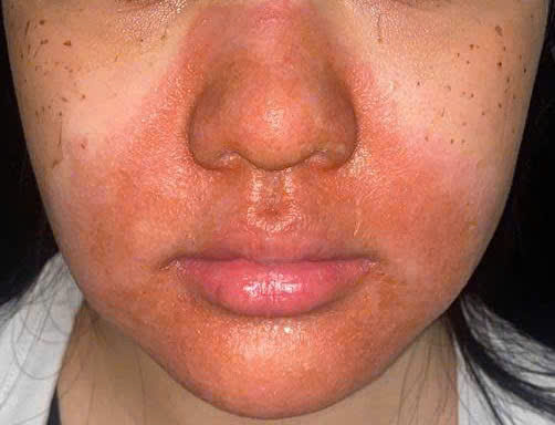 Cô gái trẻ nhập viện với gương mặt đỏ rực, bong tróc sau peel da - Ảnh 2.