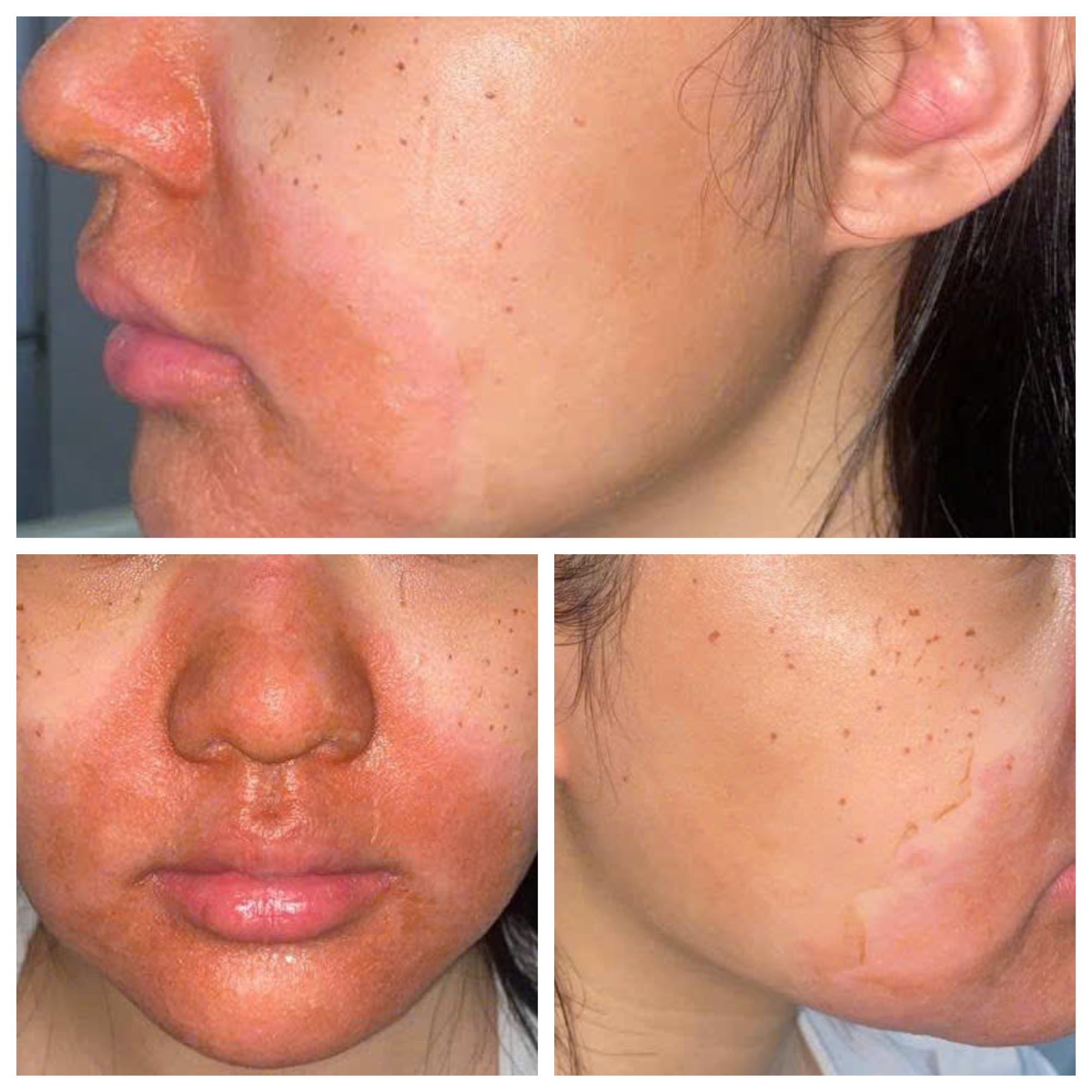 Cô gái trẻ nhập viện với gương mặt đỏ rực, bong tróc sau peel da - Ảnh 1.