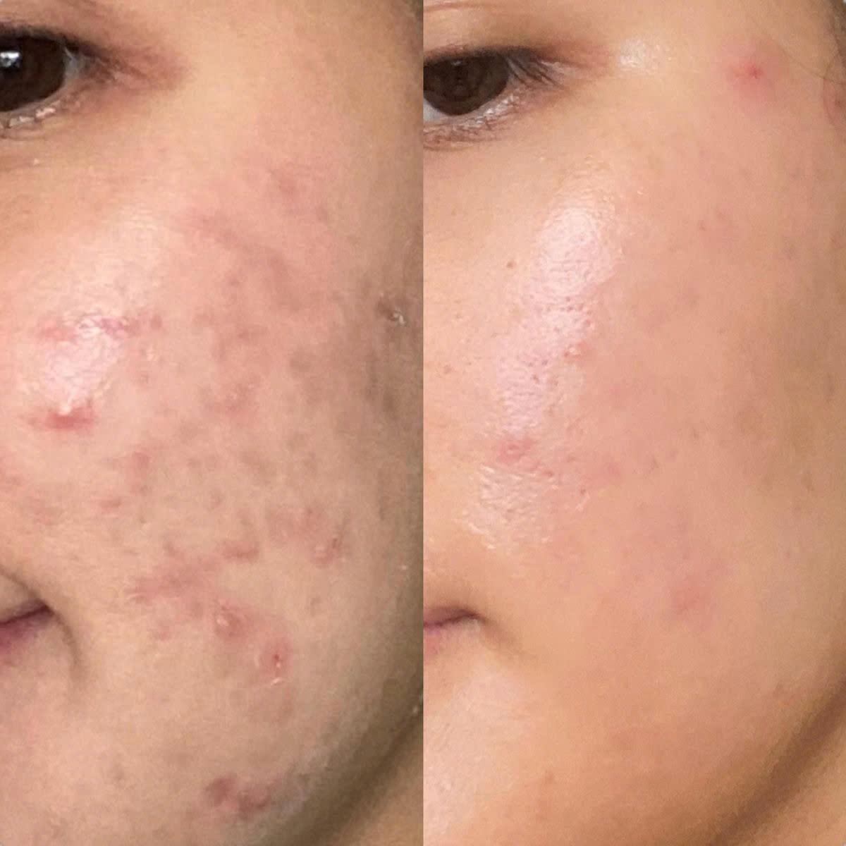 Trải nghiệm thực tế với Gel rửa mặt l&agrave;nh t&iacute;nh sạch s&acirc;u Actidem Derma Purifying Gel Cleanser - Ảnh 4.