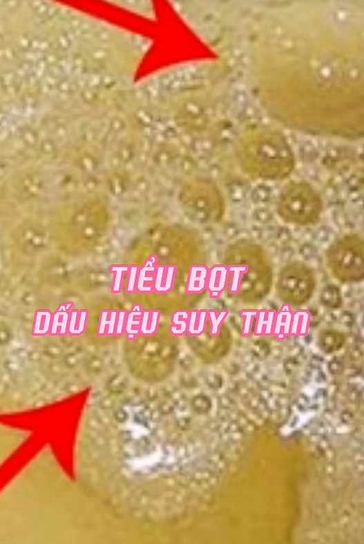Đừng l&ecirc;n TikTok t&igrave;m c&acirc;u trả lời, nếu thấy nước tiểu c&oacute; những dấu hiệu n&agrave;y th&igrave; cần đi kh&aacute;m ngay kẻo hỏng thận- Ảnh 1.