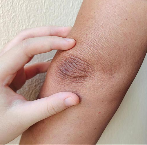 Da mặt th&acirc;m mụn, v&ugrave;ng n&aacute;ch sạm đen hay khuỷu tay th&ocirc; r&aacute;p: Phụ nữ H&agrave;n giải quyết tất cả bằng một tu&yacute;p Vitamin C - Ảnh 3.