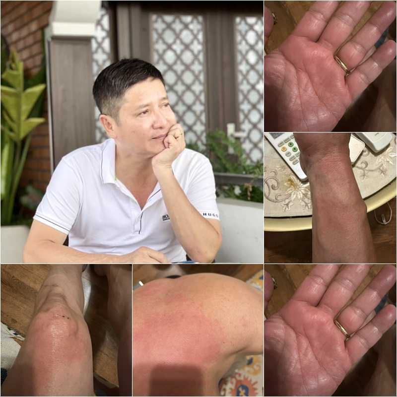 NSƯT Ch&iacute; Trung mắc bệnh lạ- Ảnh 1.