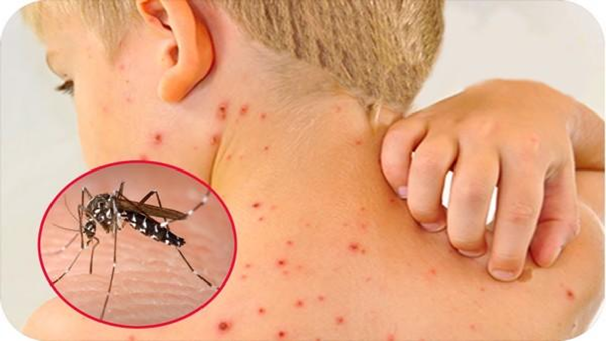 Dịch sốt xuất huyết tăng cao, chuy&ecirc;n gia cảnh b&aacute;o biến chứng nặng của bệnh - Ảnh 1.