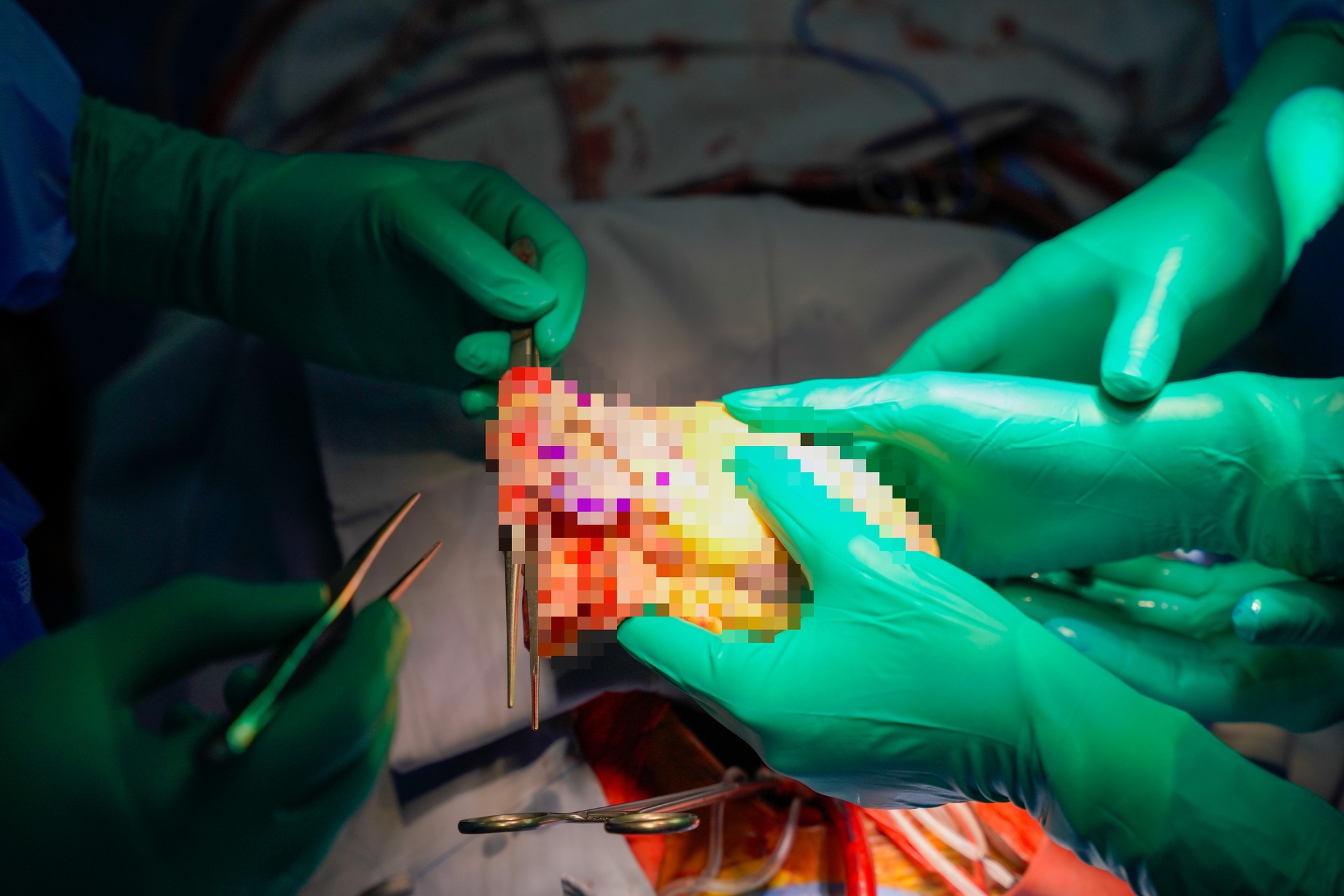 Tr&aacute;i tim bỗng đập trở lại trong lồng ngực người nhận gần ngừng tim, chạy ECMO suốt 8 ng&agrave;y, BS: "Một trong những ca hồi phục tốt nhất m&agrave; ch&uacute;ng t&ocirc;i từng thấy" - Ảnh 1.
