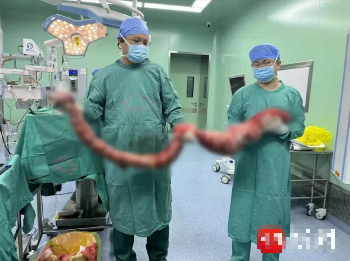 Người đ&agrave;n &ocirc;ng 4 th&aacute;ng kh&ocirc;ng đi đại tiện, bụng ph&igrave;nh to như "mang thai", b&aacute;c sĩ lấy ra thứ "đ&aacute;ng sợ"- Ảnh 2.