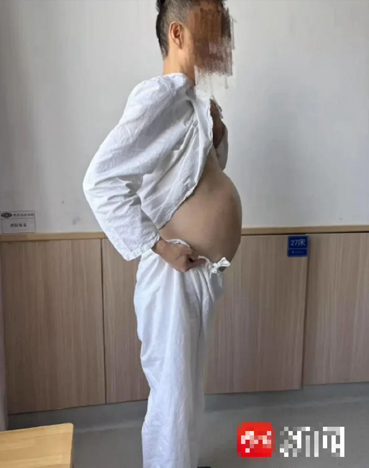 Người đ&agrave;n &ocirc;ng 4 th&aacute;ng kh&ocirc;ng đi đại tiện, bụng ph&igrave;nh to như "mang thai", b&aacute;c sĩ lấy ra thứ "đ&aacute;ng sợ"- Ảnh 1.