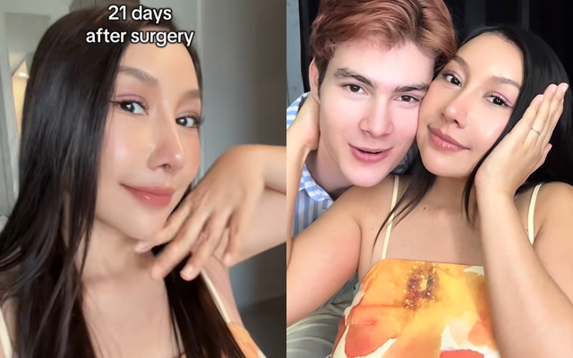 Gương mặt sau 21 ng&agrave;y phẫu thuật thẩm mỹ của c&ocirc; vợ cao 1m55 &aacute;p lực v&igrave; chồng T&acirc;y qu&aacute; đẹp trai, cao gần 2m- Ảnh 5.
