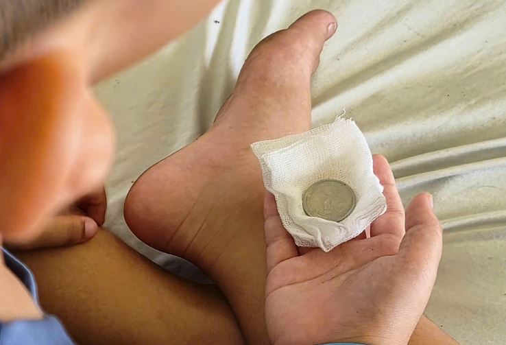 B&eacute; trai 7 tuổi li&ecirc;n tục n&ocirc;n &oacute;i, b&aacute;c sĩ gắp ra thứ "đ&aacute;ng sợ" b&ecirc;n trong - Ảnh 2.